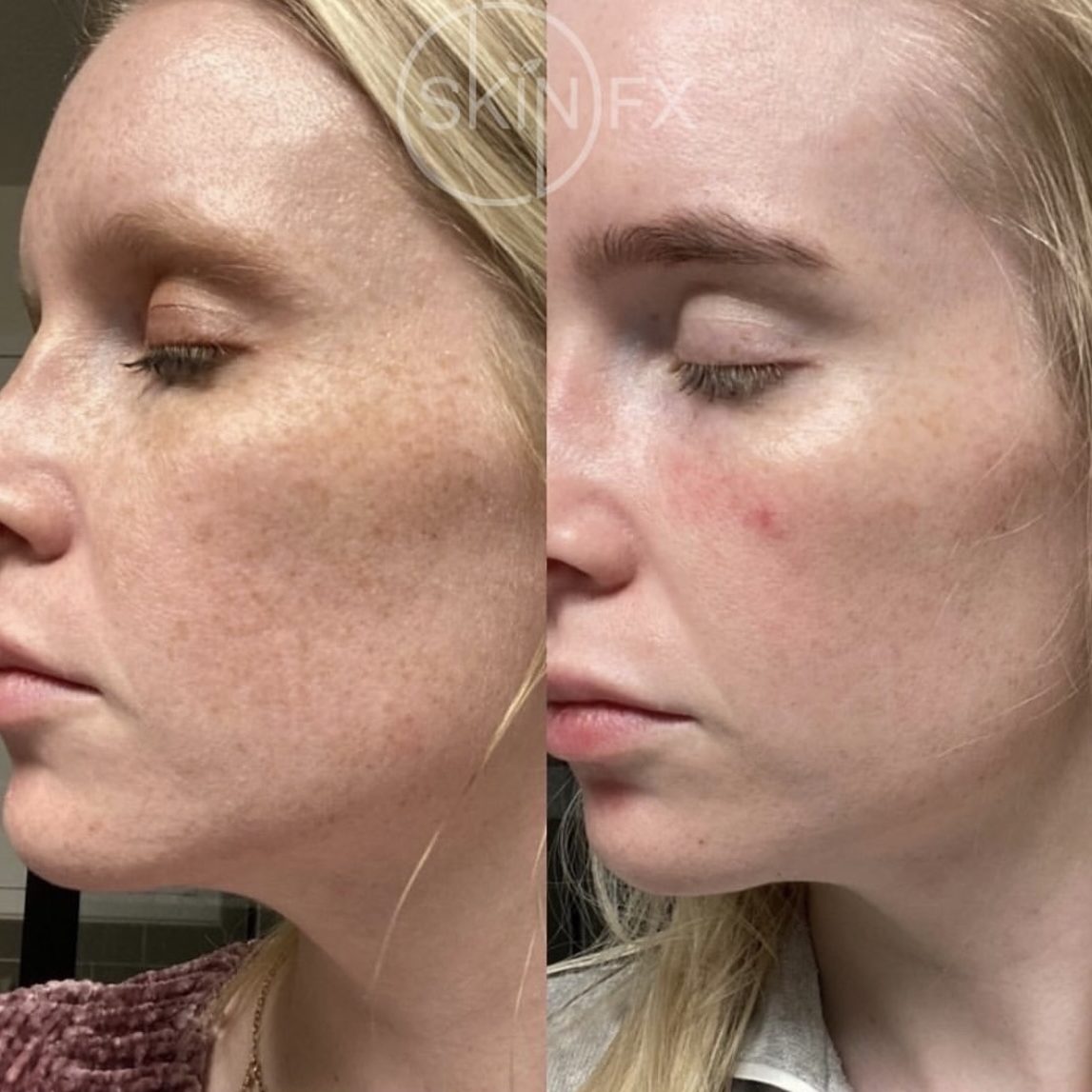 Before and after Chemical Peels