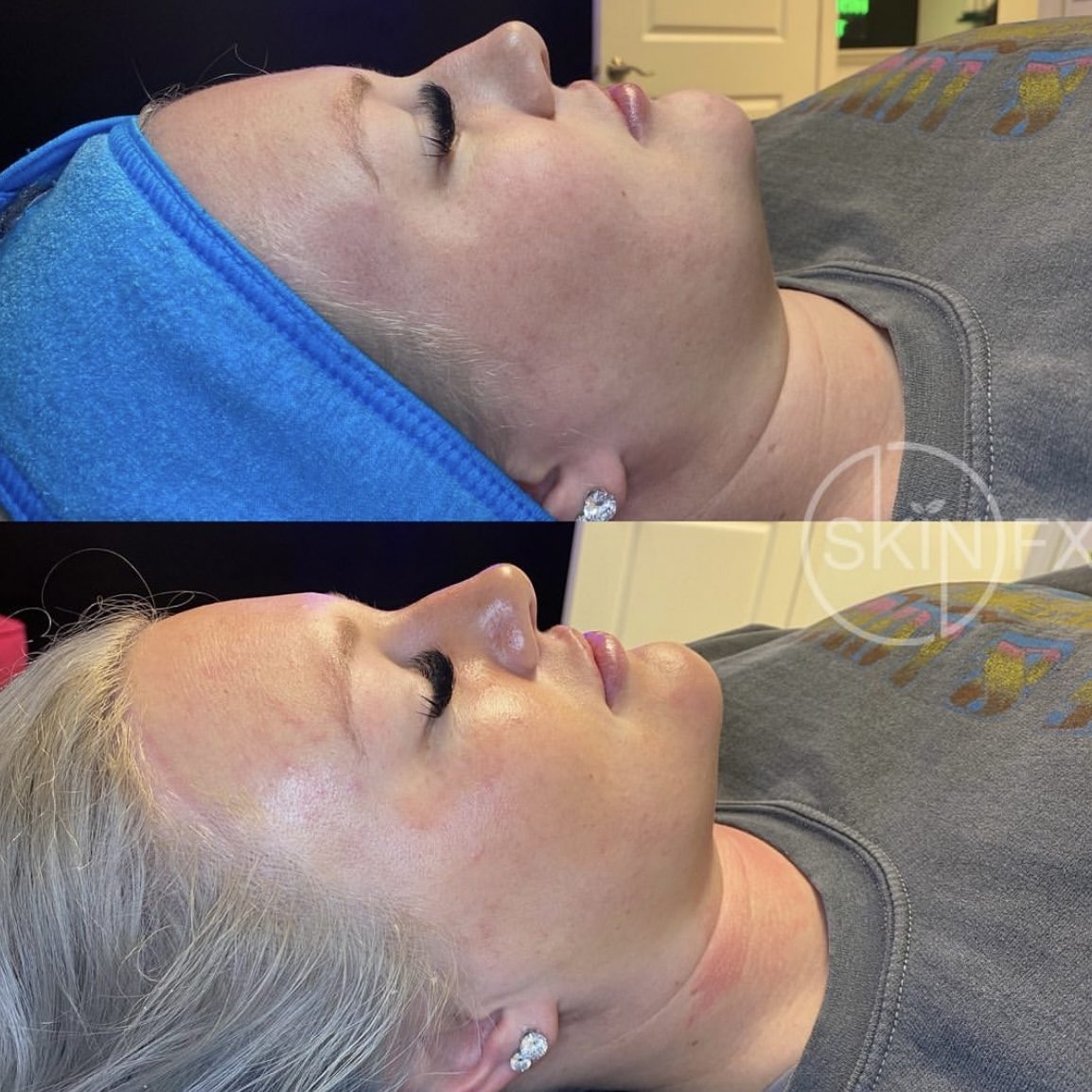 Before and after Dermaplaning
