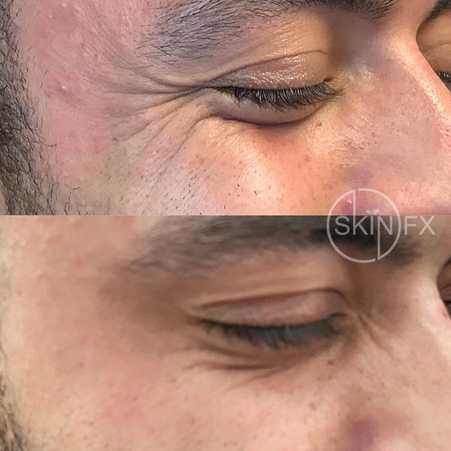 Before and after botox eye wrinkle