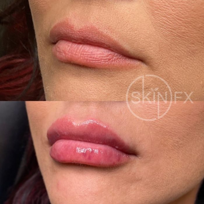 Before and After Images of a Patient That Received Lip Filler Treatments in Clinton, Utah Near Ogden