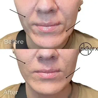 Juvederm before after at SkinFX in Clinton Near Ogden, UT