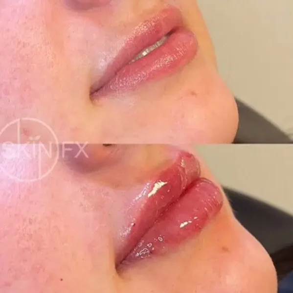 Juvederm before after1 at SkinFX in Clinton Near Ogden, UT