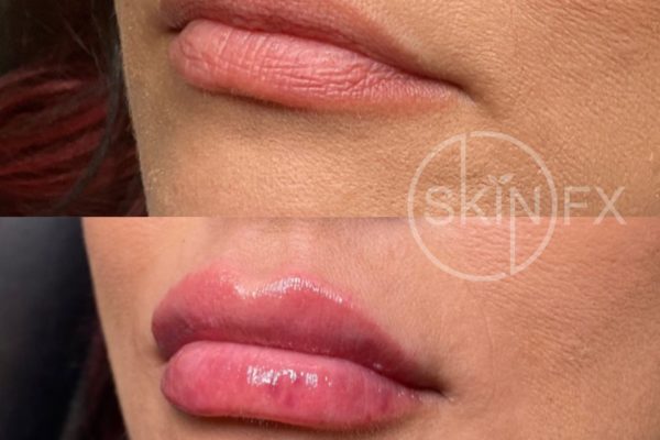 Before and After Images of a Patient That Received Lip Filler Treatments in Clinton, Utah Near Ogden